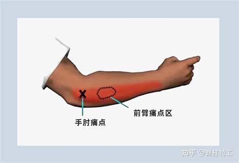 手掌小拇指下方痛|『手部疼痛地图』教你对图自查！